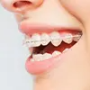 Cheapest Teeth Aligners