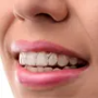 Invisible Braces