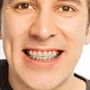 Teeth Braces for Adults